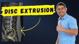 How to recover from Lumbar Disc Extrusion at home [upl. by Sille]