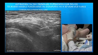 Ultrasound Guided Knee Aspiration amp Injection [upl. by Yecrad196]