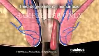 Hemorrhoid Surgery  Hemorrhoid Treatment  piles [upl. by Wesley248]