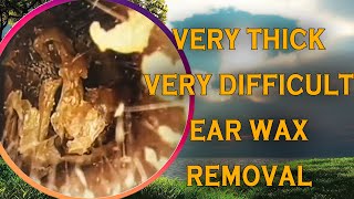 Very thick ear wax removal  Very difficult to removed  DR SEYLA [upl. by Fawna]