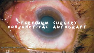 MIIQ 97 Pterygium Surgery Conjunctival Autograft with Sutures  DR MD IFTEKHER IQBAL RAJU [upl. by Ahsaekal]