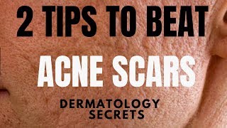 How to treat ACNE SCARS  Dermatologist reveals the best way [upl. by Kciremed252]