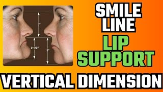 Fixed Prosthesis and Vertical Dimension Smile Line and Lip Support Planning  Class 2 [upl. by Latoniah524]