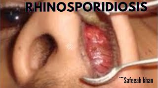 RHINOSPORIDIOSIS  Ent series Clinical features diagnosis and treatment [upl. by Ellohcin732]