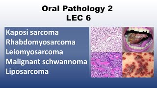 Oral Pathology 2  LEC 6 Kaposi sarcoma  Rhabdomyosarcoma  Leiomyosarcoma [upl. by Fadiman]