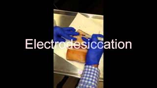 Electrodesiccation and Curettage EDampC  How To [upl. by Kolodgie]