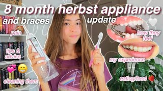 8 month HERBST APPLIANCE and BRACES update 🦷💞 my experience dental routine advice amp more [upl. by Akemat364]