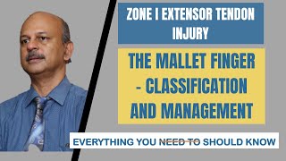 Zone I Extensor injury Mallet finger Everything you should know about it The splint the surgery [upl. by Rosita]