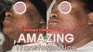 Inflamed Follicles FOLLOWUP Amazing Transformation See What We Did To Get These Results [upl. by Eniale492]