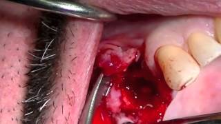 Physics Forceps Atraumatic Extraction amp Grafting in Preparation for Dental Implant [upl. by Eneri]