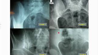 The Diagnosis and Management of Axial Spondyloarthritis [upl. by Goss]