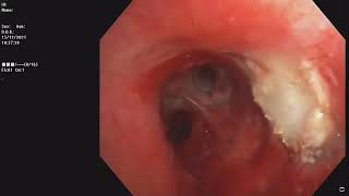 Central Airway Tumor  Bronchoscopic recanalisation  Pleomorphic adenoma [upl. by Eelyma]