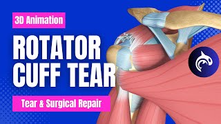 Understand Rotator Cuff Tears and Surgical Repair  3D Animation [upl. by Pilloff127]