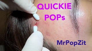 Quickie keratin plug core pops Acne extractions Link below to MrPopZit Live [upl. by Naloj524]