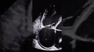 Large Atrial Septal Defect echocardiography echocardiogram cardiology [upl. by Oiruam]