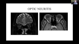 Neurosarcoidosis Presentation – Neurosarcoidosis Patient Day 2022 [upl. by Nalak]