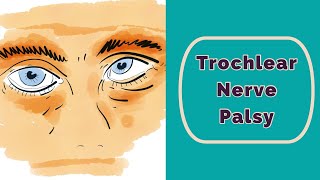 Trochlear Nerve Palsy Rapid Review [upl. by Nirroc]