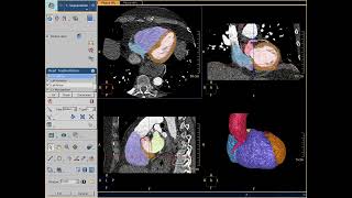 Nucradsharewordpresscom Cardiac CT processing [upl. by Tannie]