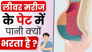 जलोदर Ascites क्या होता है  Ascites Causes Symptoms and Treatment  Bharat Homeopathy [upl. by Mera]