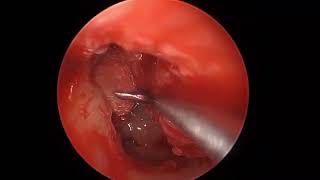 Total endoscopic retrograde mastoidectomy for cholesteatoma [upl. by Isej]