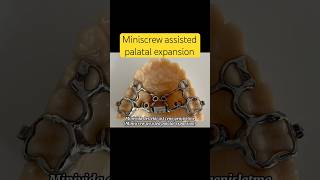 Miniscrew assisted palatal expansion dentist miniscrew manavgatdentist side [upl. by Dugas137]