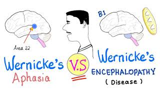 Wernicke’s Aphasia vs Wernickes Encephalopathy  Neurology [upl. by Nonnahs]