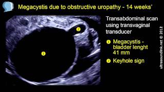 Megacystis obstructive uropathy at 12 and 14 weeks [upl. by Witherspoon]