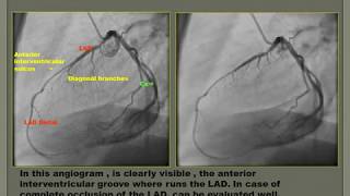 Coronary Angiography 2018 [upl. by Ardeth]