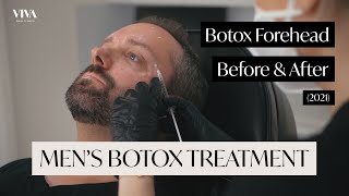 Botox Forehead Before and After 2021  Mens Botox Treatment [upl. by Assilrac]