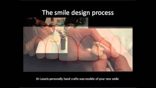 Smile design process [upl. by Symon]