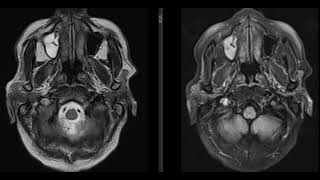 case 5  45 year old male patient with fever and headache [upl. by Sylram]