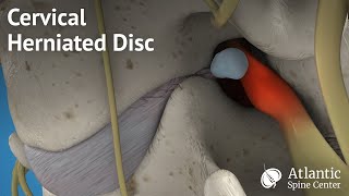 Cervical Herniated Disc [upl. by Sparhawk]