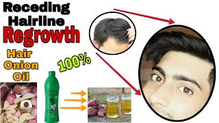 Onion Hair Oil For Receding Hairline Regrowth  How To Regrow Receding Hairline Homemade HairOil [upl. by Frymire]