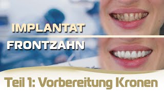 Implantat einsetzen Frontzahn Ablauf Teil 1  Vorbereitung für die Kronen und provisorische Brücke [upl. by Aseela565]