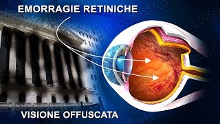 Occlusione vena centrale retinica terapia laser e chirurgica [upl. by Hines]