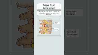 Low Back Pain 5 Key Conditions To Look Out youtube youtubeshorts lowbackpaincauses [upl. by Assej]