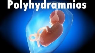 Polyhydramnios in Urdu  Causes Treatment amp Complications Increased AFI  baby water zyada hona [upl. by Femmine30]