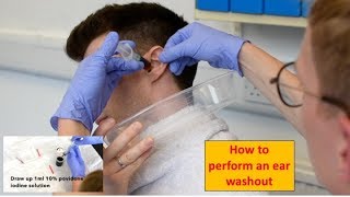 How to Perform an Ear Washout irrigation  ENTOtolaryngology Skills [upl. by Martella766]