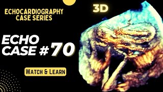 Echocardiography Case 70 Echo Spot Diagnosis Series  Cardiology [upl. by Grosvenor]