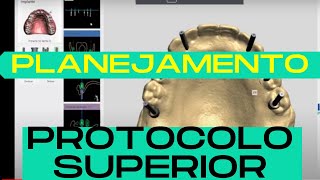 Planejamento de Cirurgia guiada  Protocolo superior dralexguedes [upl. by Ellerrad]