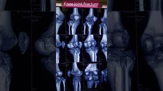 Knee joint 3D fracture  trauma patient  ct scan knee knee trending ctscan 3d fracture [upl. by Golightly193]