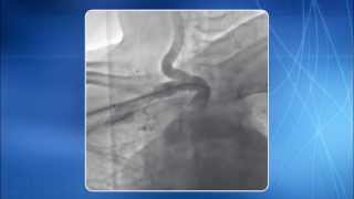 Chapter 14 TRA for addressing Subclavian amp Innominate Artery Lesions [upl. by Anibur]