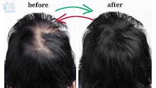 HAIR LOSS TREATMENT IN WOMEN STAGES OF FEMALE PATTERN BALDNESS [upl. by Whit]