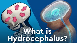 What is Hydrocephalus and Why Does Fluid Build Up in the Brain [upl. by Edee]