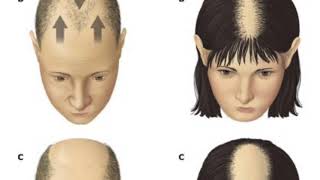 முடி கொட்டுதல்  NEW HAIR LOSS BASICS EXPLAINED AND TREATMENTSOLUTION SUGGESTED  TAMIL [upl. by Amar]