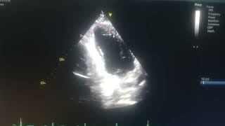 akinetic septum hypokinetic mid apical anterior and inferior wall moderate Lv [upl. by Lorine]