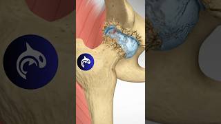 Hip Osteoarthritis  3D Animation [upl. by Leander]