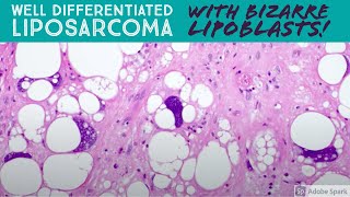 Well differentiated liposarcoma with BIZARRE pleomorphic lipoblasts 5Minute Pathology Pearls [upl. by Eustis]