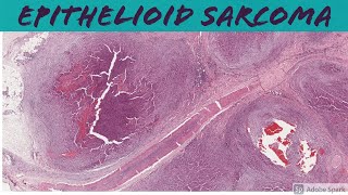 Epithelioid Sarcoma 5Minute Pathology Pearls [upl. by Pazia]