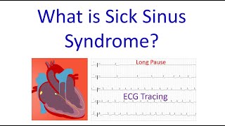 What is Sick Sinus Syndrome [upl. by Rentsch]